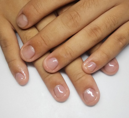 高校生の深爪矯正 幼少からの深爪をなおす ハンドとフット深爪矯正サロン 下北沢ネイルサロンアリューム