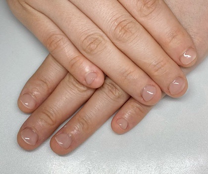 深爪矯正 結婚式にむけて深爪をなおしたい ハンドとフット深爪矯正サロン 下北沢ネイルサロンアリューム