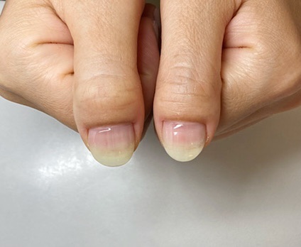 ネイルで美爪育成 爪の形がコンプレックスです ハンドとフット深爪矯正サロン 下北沢ネイルサロンアリューム