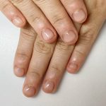 噛み爪、爪噛み矯正