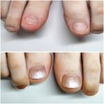 フット深爪矯正　むしり癖